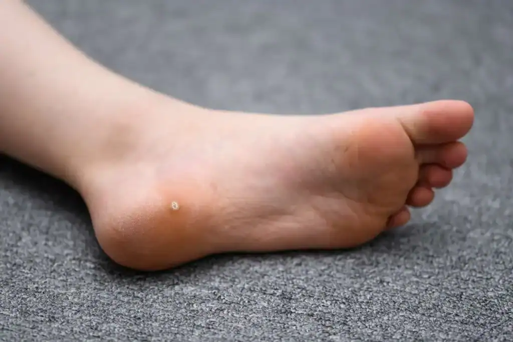 Cryotherapy For Warts And Also Verrucas 2 Image of verruca on the bottom of the foot that able to be treated with Cryotherapy Bagshot