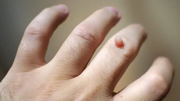 Image of blemish that Cryotherapy Bagshot can remove with Lipo 360.