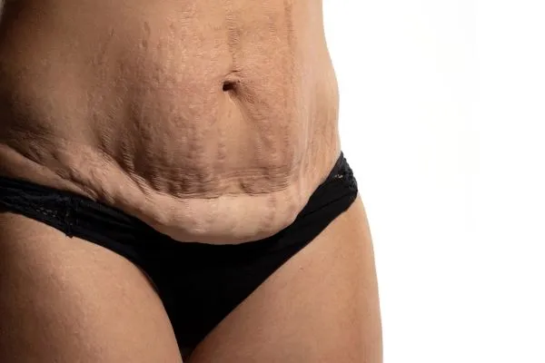 The science behind skin tightening Bagshot picture of a woman's sagging skin on the stomach